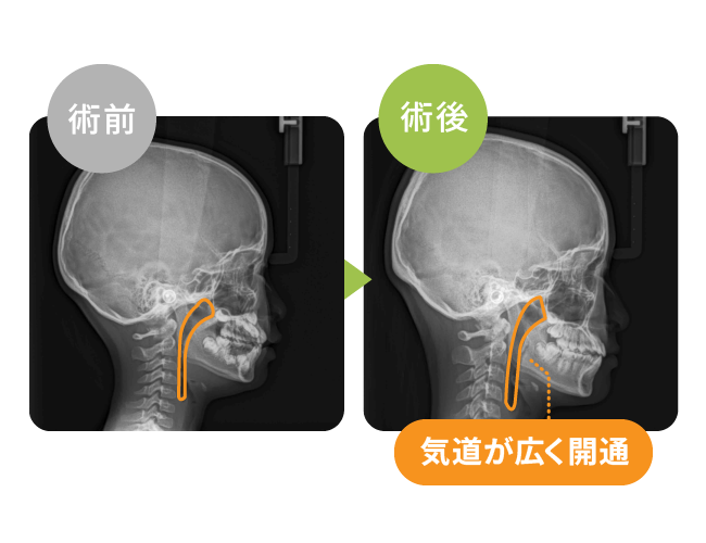 気道が広く開通