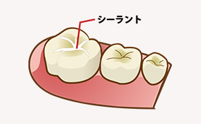 シーラント